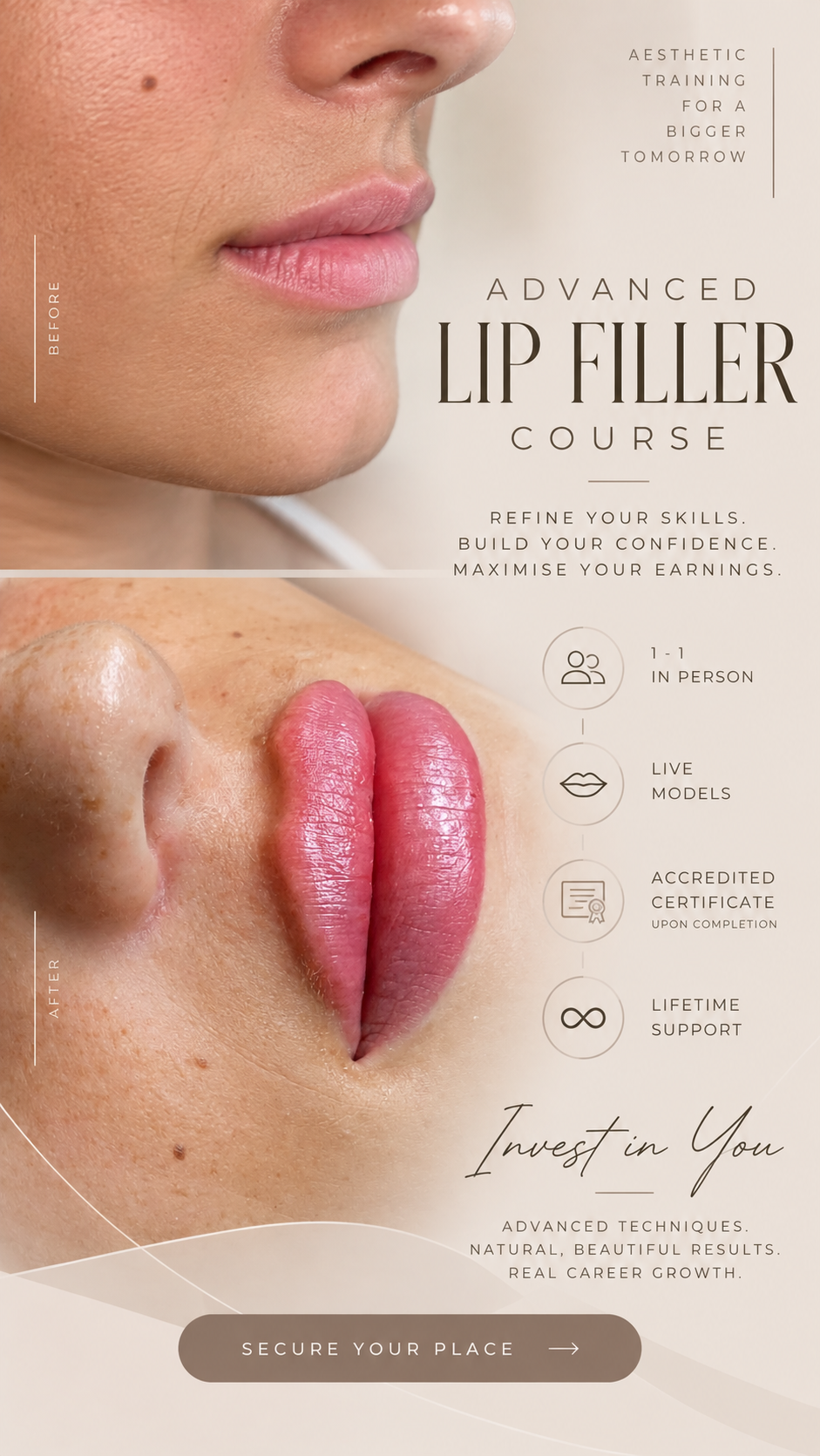 Advanced Lip Filler Masterclass
